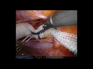 Robotic Repair of a Femoral Hernia • Video • MEDtube.net