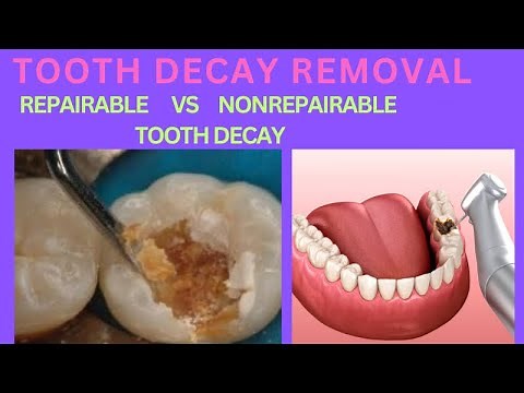 DENTAL CARIES REMOVAL PROTOCOLS TO FORM CAVITY | HOW MUCH DECAY TOOTH REMOVED FOR TOOTH FILLING