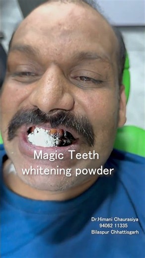 🦷✨ The Power of Teeth Whitening Powder!
