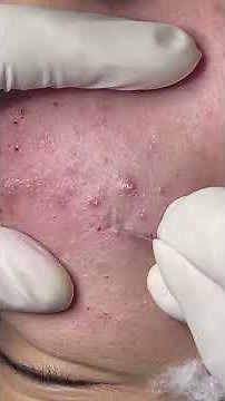 Oddly Satisfying Pimple Extractions You Can’t Miss!