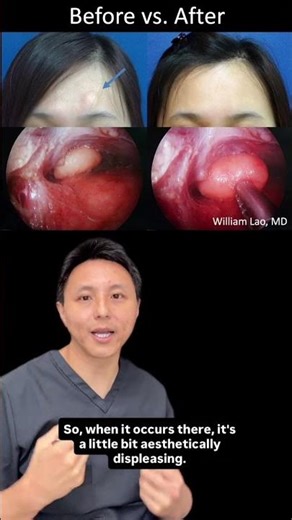 Dr Lao's Case Files 2 Forehead Lipoma