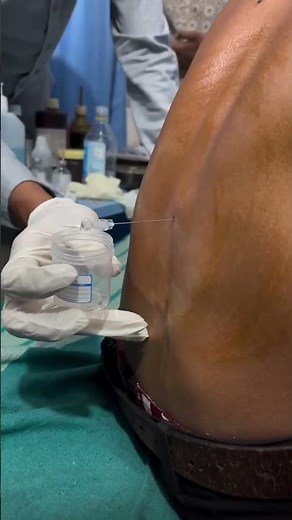 Lumbar puncture (spinal tap) – a vital procedure to collect spinal fluid for diagnosis.