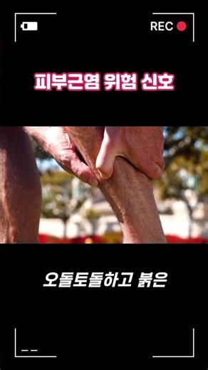 "What if your eyelids swell and your muscles lose strength?" Warning signs of dermatomyositis #sh...
