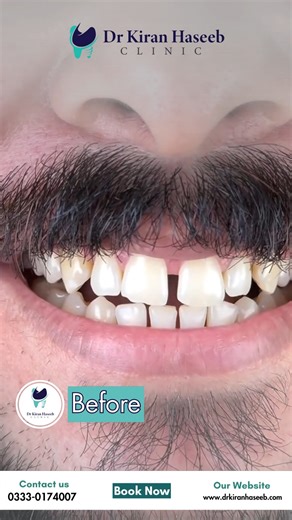 Composite bonding, also known as cosmetic fillings, is a fast and effective way to improve the appearance of your smile. In this video, Tooth Crew Clinic explains how composite bonding works, who it is suitable for, and how it can repair chips, gaps, discoloration, and uneven tooth edges. Using advanced techniques and tooth-coloured materials, our team ensures natural, safe, and long-lasting results, often achieved in a single appointment. Composite bonding is a conservative cosmetic solution de