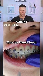 How Dentist Fox FLARED Teeth! 😮🦷 #braces #teeth #dentist | TheBentistofficial