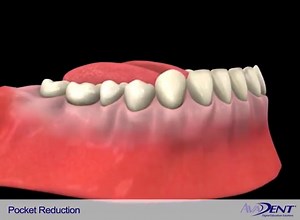 Pocket Reduction Procedure