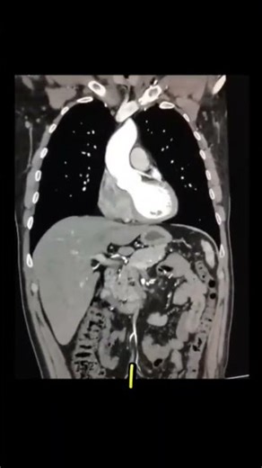 CT aortogram #foryou #medicalstudent #radiographer #radiology #medicalimaging #viral #fyp #angiogram