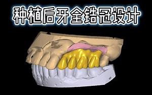 种植后牙全锆冠设计