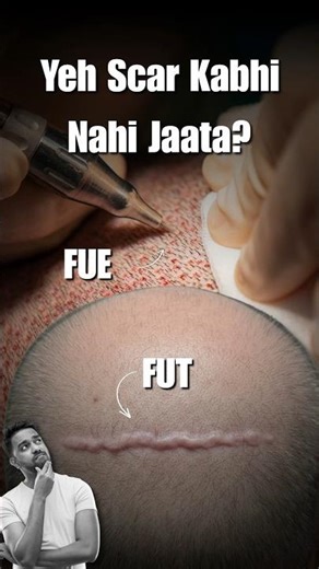 Will a Hair Transplant Leave Scars? FUE vs FUT Truth Revealed #hairrestoration #fue #fut