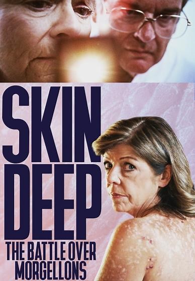 Skin Deep: The Battle Over Morgellons