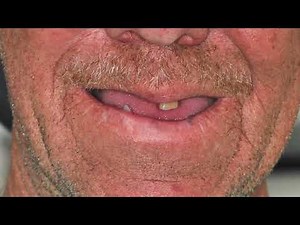 Meet Nigel | Restoring Smiles and Confidence Through Implant Dentistry at Seaham Smiles