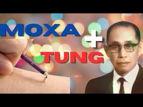 Migraine like Symptoms — Tung 's 55.06 With Moxa Made the Difference (Full-Burn Demonstration)