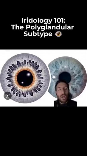 As you can see in the video, the iris tends to have a “daisy petal” appearance to it. Very pretty to look at. These “petals” are known as lacunae. To fall under this subtype, there must be 3 of these lacunae found. . What these tend to show is a potential for weakness in the glandular system as a whole. This includes the thyroid, pituitary, pineal, and gonads. In other words, there seems to be a link between this and something going on with hormones in the body. Where the lacunae are located can