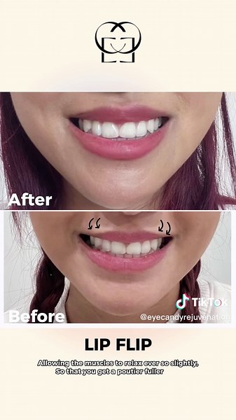 Since we have a lot of demand for #lipflip . This videos illustrates best what we do in lip flip treatment. Want to know the different between lipflip ans lip filler ? We will post it next . #botox