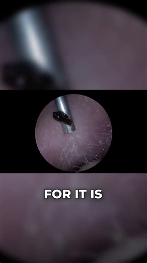 Endoscopic Earwax Removal from Swimmer | Oddly Satisfying Ear Cleaning | Wax Off Short Episode 73