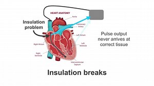 In today’s teaching video, British pacemaker expert Kristian Webb will explain what failure to capture is, why it’s important that you know about it, possible causes and what to do about it. Find out more in our Pacemaker Essentials course: https://bit.ly/38WyLQg | Medmastery | Facebook