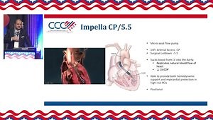 Impella, Intra-aortic Balloon Pump (IABP), and Hemodynamic Support: Key Considerations and Monitoring Aspects