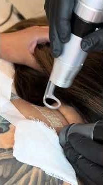Laser Tattoo Removal | Black Ink Back of Neck | What to Expect from Your First Session