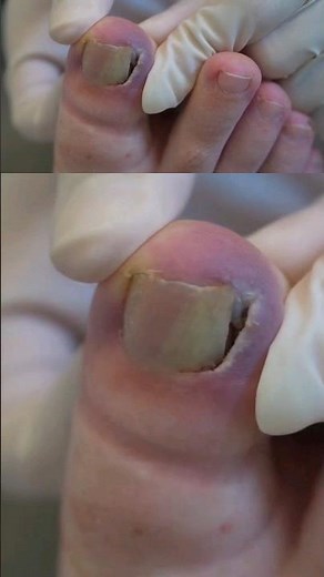 Bleeding of an ingrown nail can be made worse by doing this...