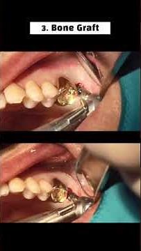 4-Week Early Loading After Maxilary Sinus Lift Using the Aqua System of SCA Kit