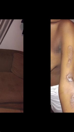 Surviving a Boiling Water and Oil Burn: Nonjabulo's Story