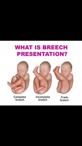 2.6K views · 401 reactions | What is Breech Presentation 樂 擄 #BreechBaby #pregnancy #breechpresentation | Mum_world_ | Facebook