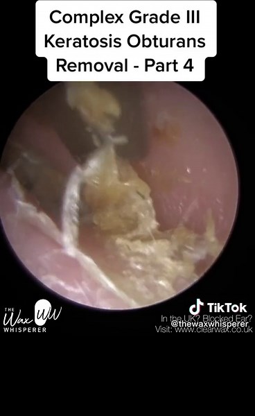 #ear #earwax #earwaxremoval #earwaxcleaning #earwaximpaction #audiologist #thewaxwhisperer