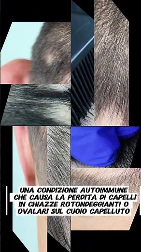 CLINICAL CASE DIAGNOSIS: ALOPECIA AREATA