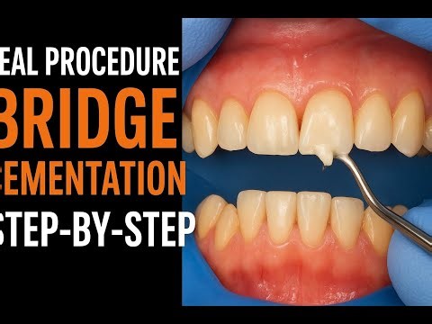 Zirconia Teeth Cementation / Step-by-Step Clinical Demonstration | Dentistry #dentistry