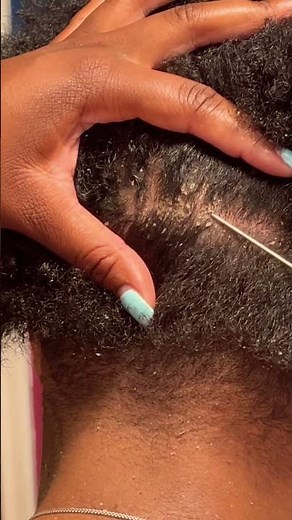 Scratching a Patch of Dandruff | Flaky Scalp #dandruffremoval #scalp scalpscratch #itchyscalp