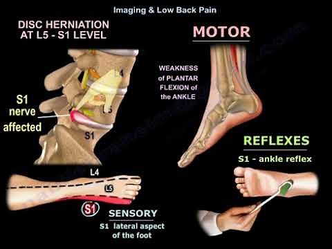 Imaging in Low Back Pain Explained