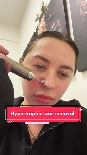 Here’s how I do hypertrophic scar removal with the Fotona SP Dynamis laser🙌🏼🙌🏼 I can also treat regular scars, pitted scars/acne scars, and even surgical scars!! #scarremoval #scartreatment #laserscartreatment