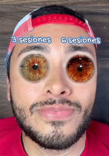 Cambio de color de ojos: despigmentación del iris