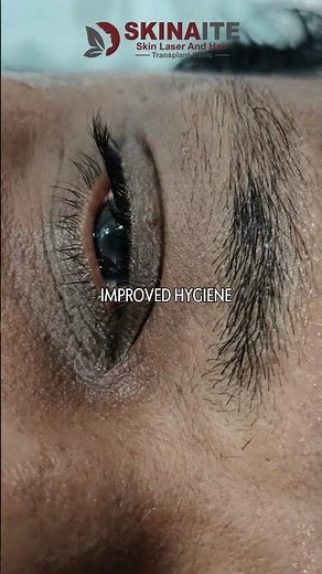 Skin Tag Removal Treatment | Quick, Safe & Effective Way to Get Clear Skin Again | Skinaite Clinic