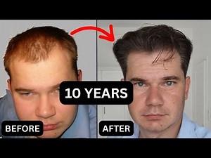 How Minoxidil Changed My Hair Over 10 Years