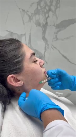 💉 Nicht-operative Jawline-Behandlungen Diese Methoden sind besonders beliebt, weil sie schnell, schmerzarm und ohne Ausfallzeit sind. 1. Jawline Filler (Hyaluronsäure) \t•\tZiel: Betonung der Kieferlinie, Ausgleich von Asymmetrien, Definition der Gesichtskontur. \t•\tMaterial: Meist Hyaluronsäure-Filler (z. B. Juvederm, Restylane). \t•\tDauer: 15–30 Minuten. \t•\tErgebnis: Sofort sichtbar, hält ca. 9–18 Monate. \t•\tNebenwirkungen: Leichte Schwellung oder blaue Flecken möglich. #haartransplanta