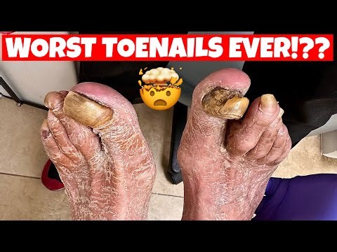 LONG DYSTROPHIC TOENAILS CUTTING!