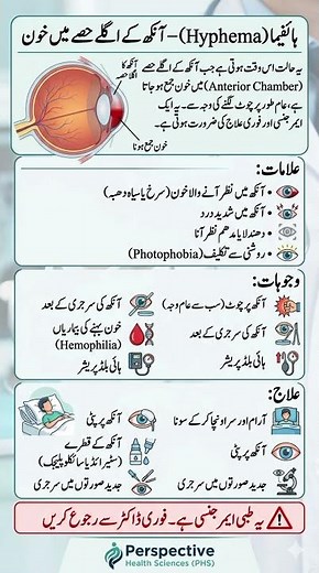 Hyphema – Blood Inside the Front of Your Eye #hyphema