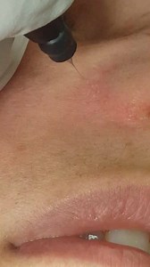 4.1K views · 37 reactions | Diathermy by Kirstie Diathermy is the removal of Telangiectasia (broken capillaries) $40 for 15mins $70 for 30mins Call 0410171438 to book Check out the video of Kirstie performing the treatment | Distinctive Features Cosmetic Tattoo and Beauty | Facebook