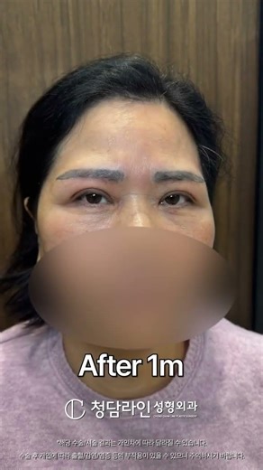 비절개 눈매교정 + 눈썹하거상 전후 비교 #shorts #비절개눈매교정 #눈썹하거상