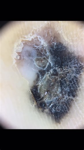 Dermato on Instagram: "• Acral lentiginous melanoma (ALM) usually arises de novo. • In rare cases, acral melanoma may develop from a pre-existing melanocytic nevus. • Acral lentiginous melanoma (ALM) generally has a poorer prognosis compared with other types of cutaneous melanoma. • Diagnosis is often made at a more advanced clinical stage. #dermoscopy #dermlite #dermatologists #dermoscopyexcellence #melanoma"