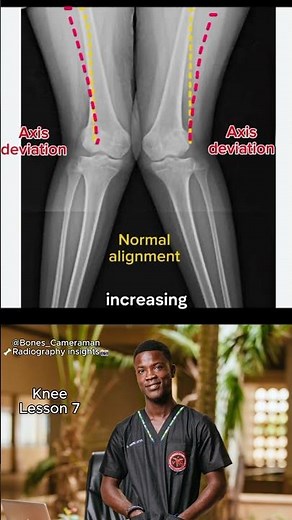 Genu Valgus (Knock Knees) Explained on X-ray | How to Identify It