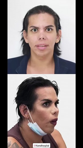 Beautiful Transformation: Dayana's Journey at Kamol Hospital