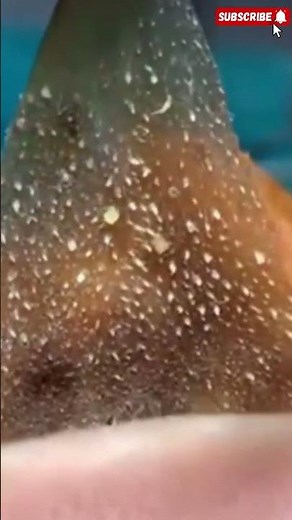 Remove Blackheads & Whiteheads with Colgate Toothpaste