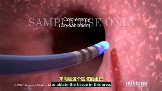 【3D医学动画】射频消融术（下）（原版中英双字幕）