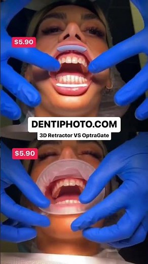 3D Dental Retractor VS OptraGate #dentalphotography #dentalcare #dental #orthodontics #dentalhygiene