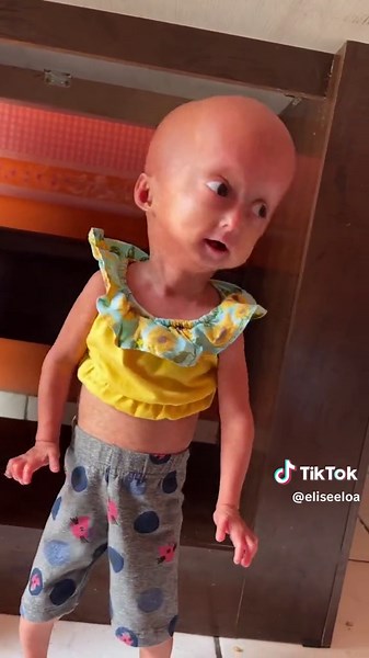Vídeo de crianças atípicas famosas (@criancasatipicas) relacionado a progeria syndrome