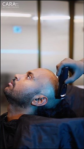 Hairline Design Before Hair Transplant Revealed