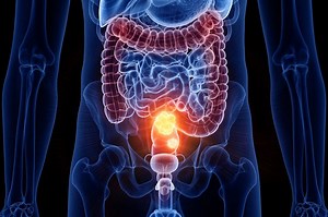 Colorectal resection: in which cases is removal necessary?