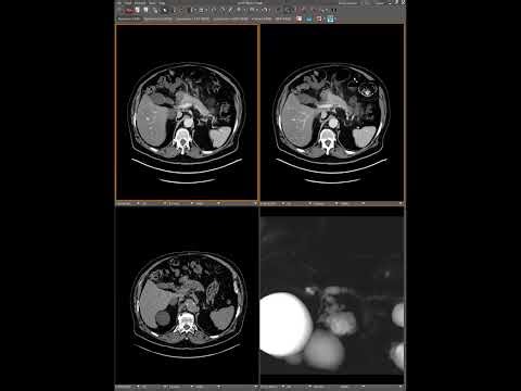 Abdominal Case Conference 2025 - Session 26